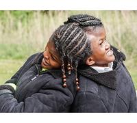 Conjoined Twin Sisters Attached At The Head