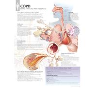 COPD (Chronic Obstructive Pulmonary Disease) Paper Poster