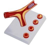 Coronary Heart Disease Human Atherosclerosis Cardiovascular Arteriosclerosis Model Thrombosis Model for Medical Education