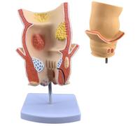 COYEUX Anatomical Rectal Pathology Model, Hemorrhoidal Disease Simulation, Anorectal Acne Model, for Rectal Intestinal Anatomy, Clinical Education, Learning Display