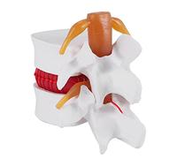 Cpolebev 1:1.5 Human Lumbar Disc Herniation Demonstration Model of Lumbar Vertebral Spine Model for Human Anatomy