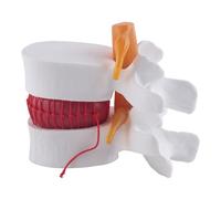 Cpolebev Human Anatomy Skeleton Spine Lumbar Disc Herniation Teaching Model Brain Skull Traumatic School Supplies Instrume