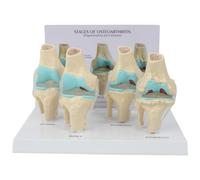 Cpolebev Knee Kit Osteoarthritis Anatomy Model with Educational Key Card 4 Stage Knee Model Orthopedic Teaching Aids