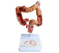 Cpolebev Teaching Model,Human Large Intestine Anatomy Model Visceral Lesion Model Human Digestive System Learning Model Easy Install