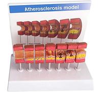CXWLD Medical Atherosclerosis Model,Artery Pathology Artery Anatomical Model,Blood Vessel Anatomy Thrombus Blood Fat Model Medical Aid