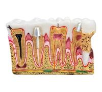 Dental Anatomy Model, Caries Comparison Study Models Dentist Dental Anatomy Education Teeth Model Dental Caries Developing Model for Dental Studies & Research