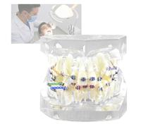 Dental Caries Comparation Anatomy Teeth Model-Resin Material Realistic Simulation Teeth Model For Practice And Teaching