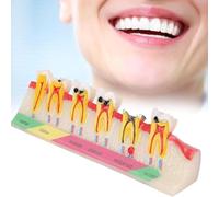 Dental Caries Developing Model, Teeth Anatomy Education Model, Dental Tooth Pathology Display Tooth, Shows The Whole Process of Caries Development, for Teeth Typodont Study & Education