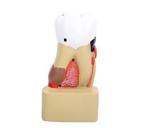 Dental Caries Model Tooth Decay Model Dental Comprehensive Disease Pathological Model Scientific Educational Supplies for School Teaching Research