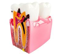 Dental Caries Teeth Model, 3.4 x 3 x 2 Inches - 6 Times Enlarged Dental Anatomy Education Tooth Model - Caries Teaching Typodont Tool for Dentists, Patients, Teachers, and Students