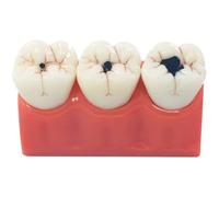 Dental Caries Teeth Model, Dental Anatomy Education Tooth Model, 4 Times Caries Teaching Typodont Tool for Dentists Teachers Students