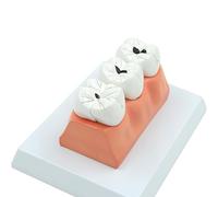 Dental Caries Teeth Model, Detachable Stomatology Caries Decomposition Teeth Model, 4 Times Magnification and Display 3 Stages Of Caries Evolution, for Medical Teaching.