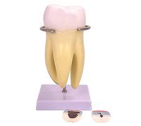 Dental Caries Teeth Model, New Dental Teeth Model with Display Base and Tooth Cross-Section Display, Removable 3 Caries Teeth & Dental Nerve 6 Parts, for Demonstration, Studying, Teaching