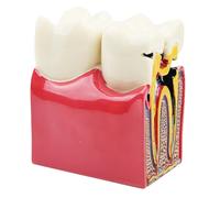 Dental Caries Teeth Model Tooth Decay Bilateral Comparison Study 6 Times Pathology Cross-Section Demonstration Anatomy Education for Doctor-Patient Communication, Medical Teaching