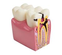 Dental Caries Tooth Model Decay Dental Patient Education Teeth Model 6 Times Caries Comparation Study Model Teaching Tools