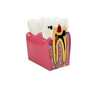 Dental Caries Tooth Model, YOUYA DENTAL Decay Teeth Comparative Study Model 6 Times Caries Tooth Teaching Tools