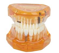 Dental Education Models, Baby Teeth Model, Teeth Dental Demonstration Model, Dental Demonstration Teeth Model Dental Demonstration Teeth Model Orange Color Removable Demonstration Denture Model f