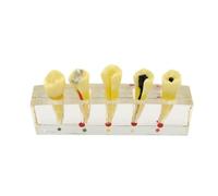 Dental Endodontics Treatment Model 5 Stages Of Root Canal Procedure Incisor 2Nd Premolar Teeth Disease Comparation Study Models Dental Materials Anterior Root Canal Practice Demonstration Model