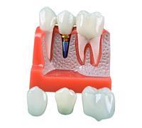 Dental Implant Educational Model, 4X Size, Demonstration Crown and Bridge Display with Base