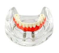 Dental Implant Model 4 Implants Low Jaw Teeth Models Overdenture Restoration Typodont For Education Teaching