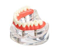 Dental Implant Model Overdenture Upper Jaw Teeth Removable Implant Screws Typodont Model for Decorating Education（4 Implants Comes with A Screwdriver）