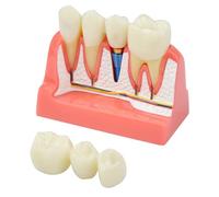 Dental Implant Model Removable Crown Bridge 4 Times for Stutent Study,Teaching Demonstration and Patient Education