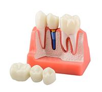 Dental Implant Model with Crown Bridge and Removeable Crowns for Education-Normal