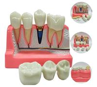 Dental Implant Teach Crown Bridge Removable Model Porcelain Teeth Model Dental Demonstration Model For Dentist Teaching