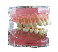 Dental Implant Teeth Model,with Soft Gum and Extractable Removable Resin Teeth for Practice and Teaching