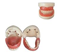 Dental Implants Model, Detachable Teeth Denture Model, Full Mouth Overdenture with 4 Implants Demo for Education School Teaching, Studying, Demonstration