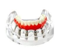 Dental Lower 4/6 Implants Removable Overdenture Restoration Maxillary Teeth Model Dentist Student Education Typodont Implant(Lower 6implant)