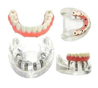 Dental Lower Tooth Implant Model Overdenture Teeth Removable Implant Model For Researching Medical Dentist Teaching Studying