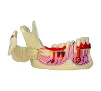 Dental Model Tool for Demonstrating Oral Caries, Root Cyst, and Mandibular Decomposition for Educational Use by Dentists and Educators