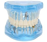 Dental Oral Typodont Model, Acrylic Blue Dental Models, Transparent Mouth Model, Teeth Model Compatiable for Dental Study, Teaching, Research