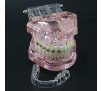 Dental Orthodontic Demonstration Model,Dental Teeth Orthodontic Retainer Treatment Model with Metal Self-ligating Brackets Explaining Model
