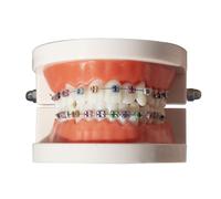 Dental Orthodontic Demonstration Model with Metal Bracket Standard Teeth Treatment Teaching Studying Explaining Model