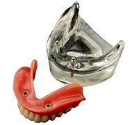 Dental Overdenture Inferior Model Removable Demo Model, 2 Implants Demo, for Teaching, Studying, Displaying, Patient Communication