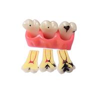 Dental Pathology Model - 4X Large Teeth Model for Shallow and Deep Caries Patient Demo and Teaching