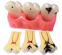 Dental Pathology Model, 4X Teeth Model Caries Pathological Model, Caries Decomposition Model, Dental Teeth Model Shallow Caries Deep Caries Patient Demo Teaching Model