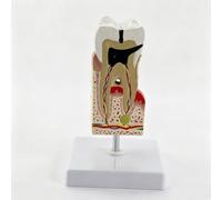 Dental Pathology Model Resin Dentist Office Cavity Disease Study Display-Model