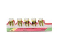Dental Periodontal Disease Model, Teeth Periodontal Disease Model Different Stages Resin Dental Periodontitis Display Model