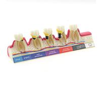 Dental Periodontal Disease Teeth Model Doctor-Patient and Oral Care Education Model