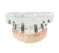 Dental Removable Implant Model Dental Teaching Demonstration Of Maxillary Covered Dentures With 4 Implants