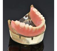 Dental Restoration Model, Dental Overdenture Teeth Model, Removable Lower Jaw Teeth 4 Implants Demo for Teaching and Studying