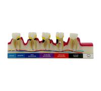 Dental Teeth Model 6 Stage Periodontal Disease Demonstration Model for Dental Education