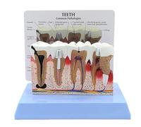 Dental Teeth Model, Human Teeth Dental Model Anatomy Model, with Instructions, Pathology Demonstration Dental Model, for Dentist Office Educational Learning Tool