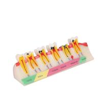Dental Tooth Decay Model, Teeth Teaching Dental Caries Tooth Model Resin Caries Bilateral Comparison Pathology Model Teeth for Dental Education Supplies, Tooth Pathology Display