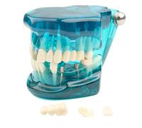 Dental Transparent Disease Teeth Model lmplant Analysis Demonstration Standard Typodont Training Tooth with Removable Crown Bridge for Student Education（Blue）(Blue)