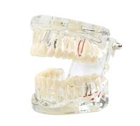 Dental Transparent Disease Teeth Model lmplant Analysis Demonstration Standard Typodont Training Tooth with Removable Crown Bridge for Student Education（Blue）(Clear)