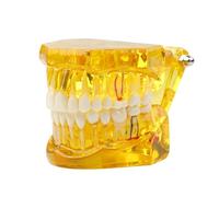 Dental Transparent Disease Teeth Model lmplant Analysis Demonstration Standard Typodont Training Tooth with Removable Crown Bridge for Student Education（Blue）(Yellow)